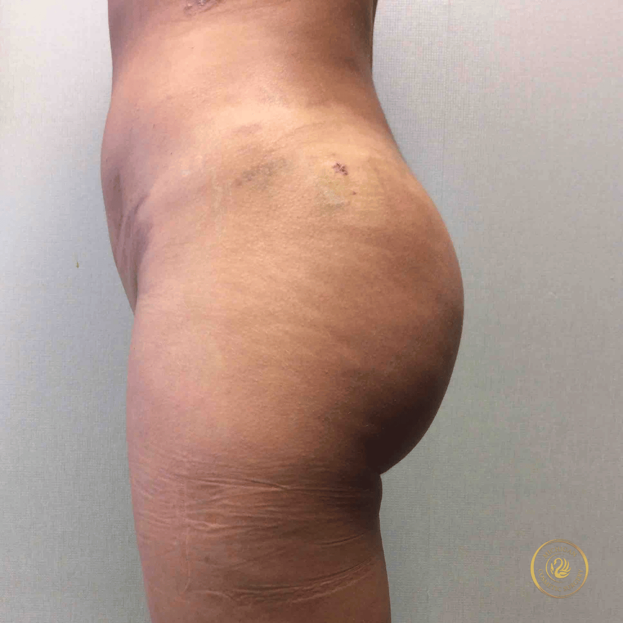 liposuction after photo by michigan cosmetic surgery in southfield mi