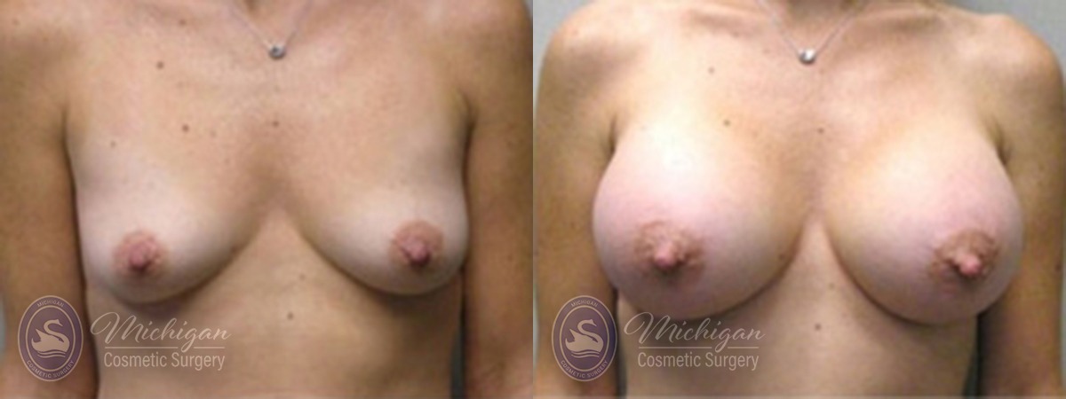 Michigan Cosmetic Surgery Southfield Breast Augmentation P