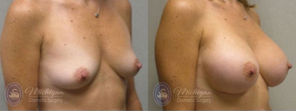 Michigan Cosmetic Surgery Southfield Breast Augmentation P