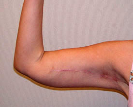 arm lift after photo by michigan cosmetic surgery in southfield mi