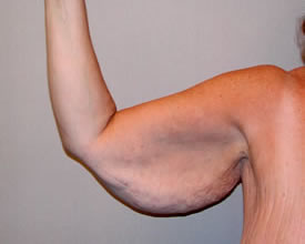 arm lift before photo by michigan cosmetic surgery in southfield mi