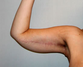 arm lift after photo by michigan cosmetic surgery in southfield mi