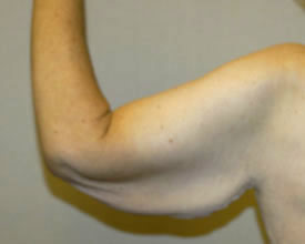 arm lift before photo by michigan cosmetic surgery in southfield mi
