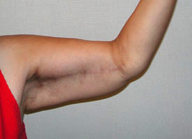 arm lift after photo by michigan cosmetic surgery in southfield mi