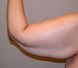 arm lift before photo by michigan cosmetic surgery in southfield mi