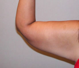 arm lift after photo by michigan cosmetic surgery in southfield mi