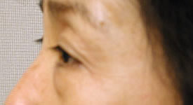 blepharoplasty before photo by michigan cosmetic surgery in southfield mi