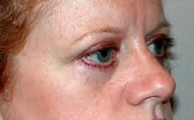blepharoplasty after photo by michigan cosmetic surgery in southfield mi