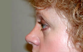 blepharoplasty after photo by michigan cosmetic surgery in southfield mi