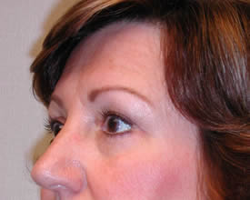 blepharoplasty after photo by michigan cosmetic surgery in southfield mi