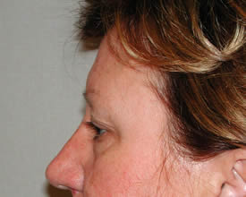 blepharoplasty before photo by michigan cosmetic surgery in southfield mi