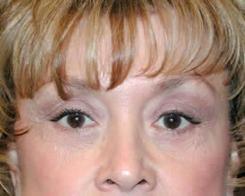 blepharoplasty after photo by michigan cosmetic surgery in southfield mi