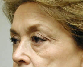 blepharoplasty before photo by michigan cosmetic surgery in southfield mi