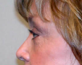 blepharoplasty after photo by michigan cosmetic surgery in southfield mi