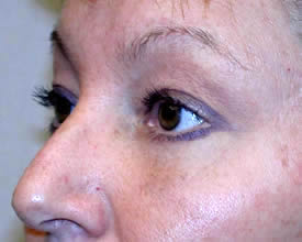 blepharoplasty after photo by michigan cosmetic surgery in southfield mi