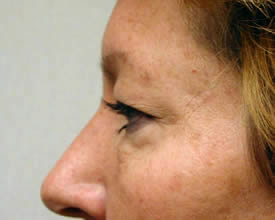 blepharoplasty before photo by michigan cosmetic surgery in southfield mi