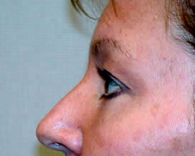 blepharoplasty after photo by michigan cosmetic surgery in southfield mi