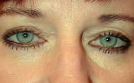 blepharoplasty after photo by michigan cosmetic surgery in southfield mi