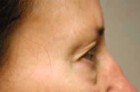 blepharoplasty before photo by michigan cosmetic surgery in southfield mi