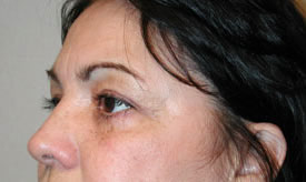 blepharoplasty after photo by michigan cosmetic surgery in southfield mi