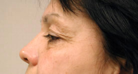blepharoplasty before photo by michigan cosmetic surgery in southfield mi