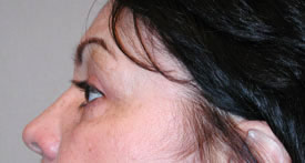 blepharoplasty after photo by michigan cosmetic surgery in southfield mi