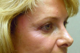 blepharoplasty after photo by michigan cosmetic surgery in southfield mi