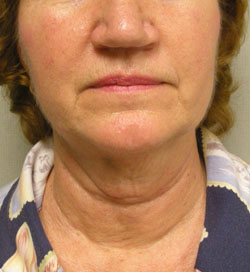 facelift before photo by michigan cosmetic surgery in southfield mi
