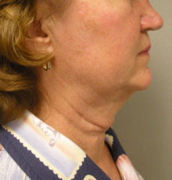 facelift before photo by michigan cosmetic surgery in southfield mi