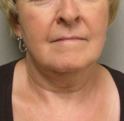 facelift before photo by michigan cosmetic surgery in southfield mi