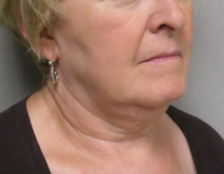 facelift before photo by michigan cosmetic surgery in southfield mi