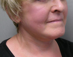 facelift after photo by michigan cosmetic surgery in southfield mi