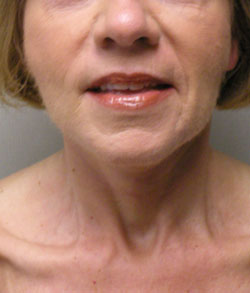 facelift after photo by michigan cosmetic surgery in southfield mi