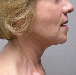 facelift after photo by michigan cosmetic surgery in southfield mi