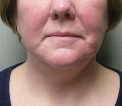 facelift after photo by michigan cosmetic surgery in southfield mi