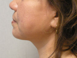 facelift after photo by michigan cosmetic surgery in southfield mi