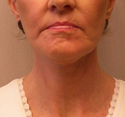 facelift after photo by michigan cosmetic surgery in southfield mi