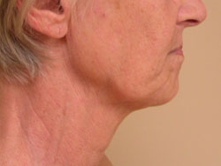 facelift before photo by michigan cosmetic surgery in southfield mi