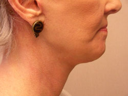 facelift after photo by michigan cosmetic surgery in southfield mi