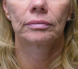 facelift before photo by michigan cosmetic surgery in southfield mi
