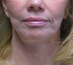 facelift after photo by michigan cosmetic surgery in southfield mi