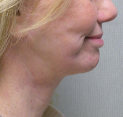 facelift after photo by michigan cosmetic surgery in southfield mi