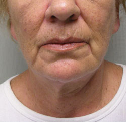 facelift before photo by michigan cosmetic surgery in southfield mi