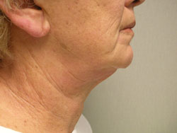 facelift before photo by michigan cosmetic surgery in southfield mi