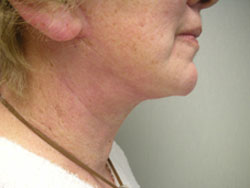 facelift after photo by michigan cosmetic surgery in southfield mi