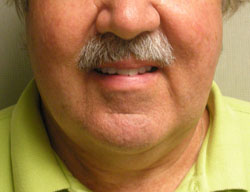 facelift before photo by michigan cosmetic surgery in southfield mi