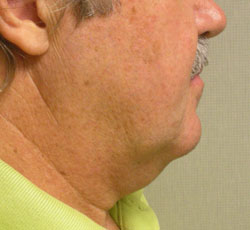 facelift before photo by michigan cosmetic surgery in southfield mi