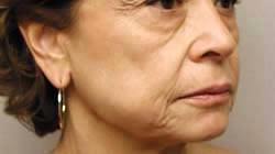 facelift before photo by michigan cosmetic surgery in southfield mi