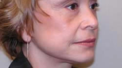 facelift after photo by michigan cosmetic surgery in southfield mi