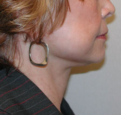 facelift after photo by michigan cosmetic surgery in southfield mi